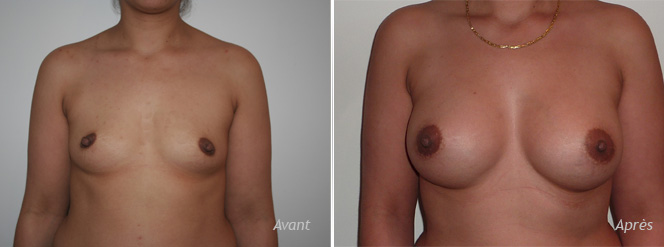 implants mammaires anatomiques retrofascial