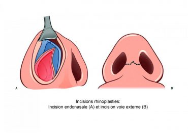 rhinoplastie-incisions