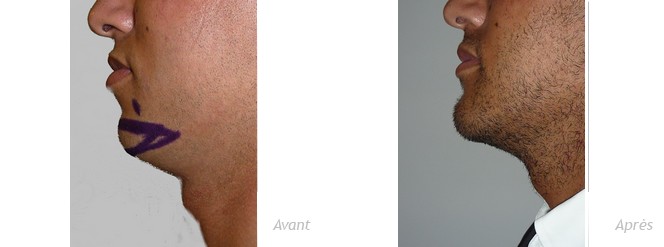 genioplastie-implant-anatomique-menton-homme-photo-avant_après