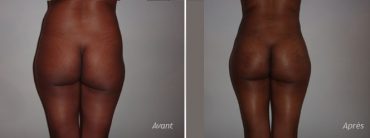 implants fesses liposuccion hanches - photos - avant_après