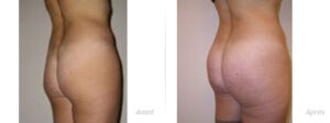 Implants de fesses avant / après par le dr Ouakil à Paris
