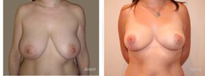 lifting mammaire réduction seins cicatrices