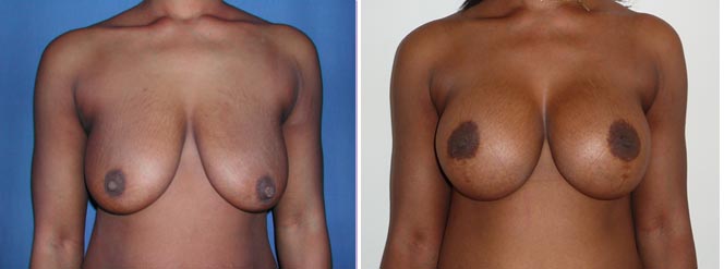 avant/après lifting mammaire implants peau noire