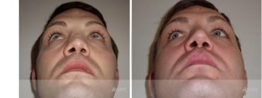 rhinoplastie-pointe-avant_apres-reconstruction-implant-Medpor Rhinoplastie secondaire de la pointe et de l'arête par implant de Medpor