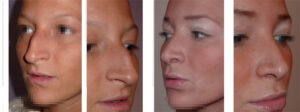 photos résultat rhinoplastie et implants de lèvres Permalip