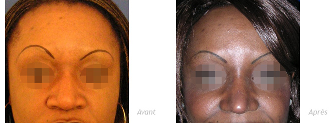 Rhinoplastie ethnique femme africaine peau noire augmentation réduction narines photos avant après