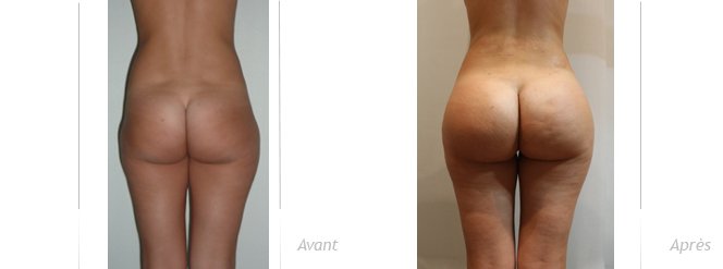 Augmentation fessiers implant anatomiques 350 et lipofilling des creux