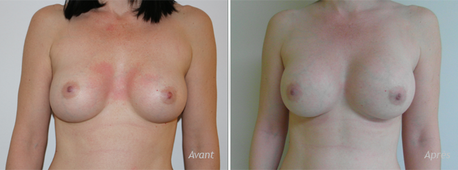 implants mammaires choix implants mammaires choix