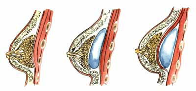 position des implants mammaires muscle pectoral