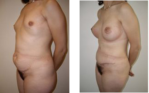 abdominoplastie-implants-mammaires-avant-apres abdominoplastie-implants-mammaires-avant-apres