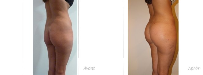 implants-fessiers-lipomodelage-avant/apres