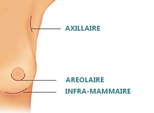 implants mammaires incisions