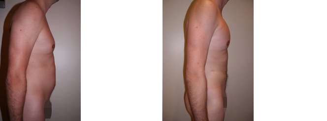 implants de pectoraux + lipofilling-liposuccion abdominale implant-pectoral-lipofilling-liposuccion-abdomen