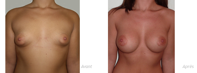 implants-mammaires-anatomiques-seins-tubereux-resultat