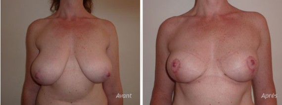 mastopexie-reduction-mammaire-asymetrie-avant-apres
