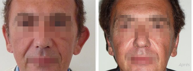 otoplastie pour asymétrie des oreilles décollées chez un adulte