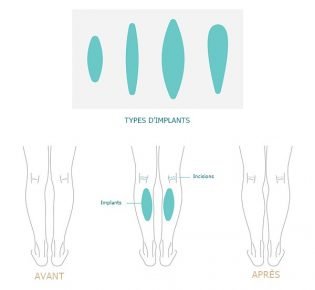 implant-mollet