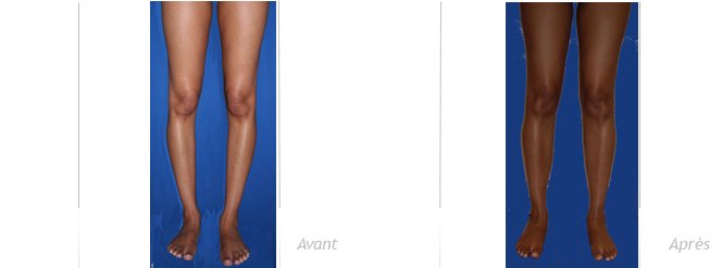 implant-mollet-peau-noire-avant-apres