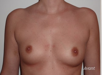 implants-asymetrie-mammaire-avant
