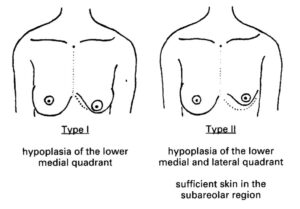 seins tubéreux - schéma des grades 1 et 2 