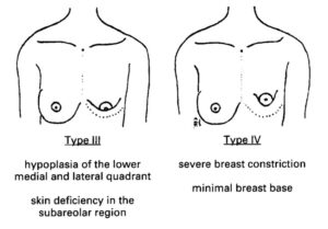 seins tubéreux - schéma des grades 3 et 4