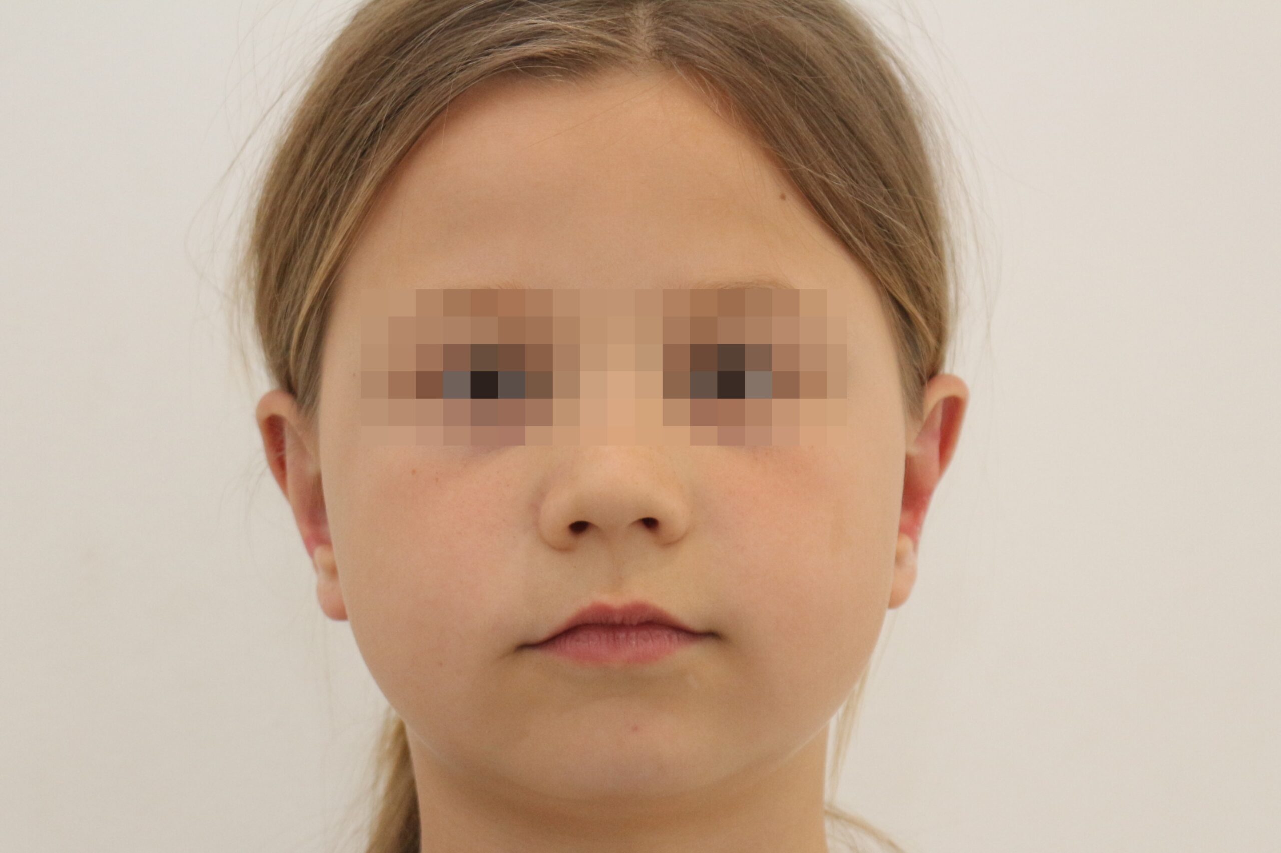 image après otoplastie pour oreille décollée chez une jeune enfant