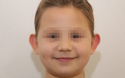 image avant otoplastie oreille décollée enfant