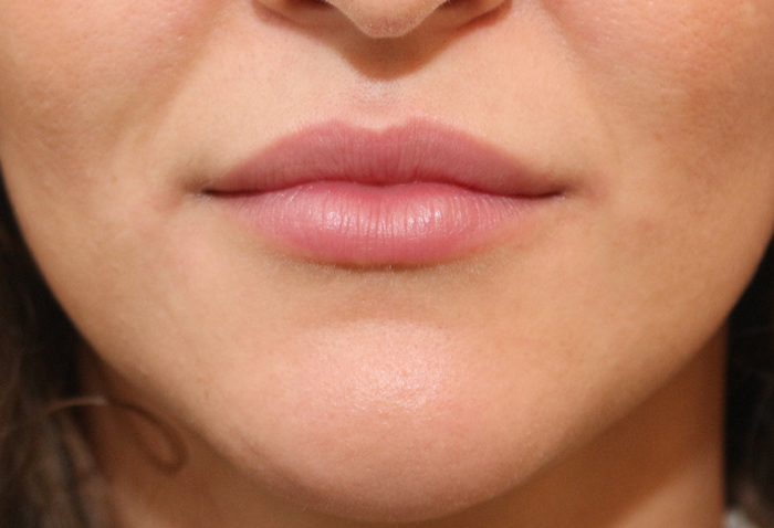 Injection des lèvres par acide hyaluronique avant après