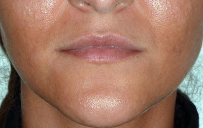 Injection d'augmentation des lèvres par acide hyaluronique avant