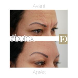 Avant / après injection de Botox par le dr Ouakil à Paris