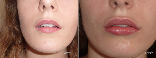 augmentation-lèvre-supérieure-inférieure-implant-permanent-permalip- 4mm-