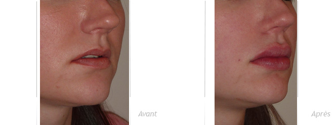 injection lèvres sillon naso-génien résultat photos avant-après