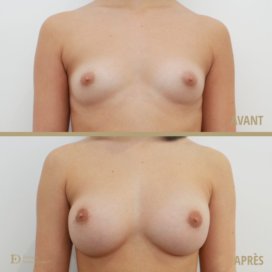 résultat-implant-mammaire-poitrine
