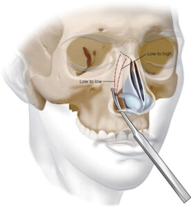 Schéma de l'ostéotomie latérale nasale pendant une rhinoplastie